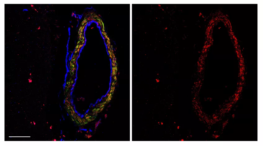 Researchers examined brain surface blood vessels. The artery lining appears blue, muscle cells regulating blood flow green, and red clusters show Alzheimer’s-linked amyloid beta. Photo: Ilknur Özen et al